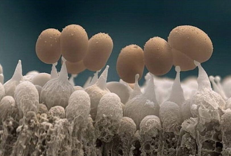 Μύκητας των νυχιών κάτω από το μικροσκόπιο