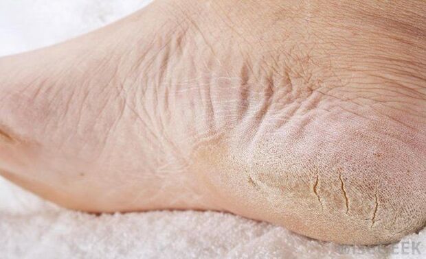 Τα ξηρά πόδια είναι σημάδι μυκητιακής λοίμωξης