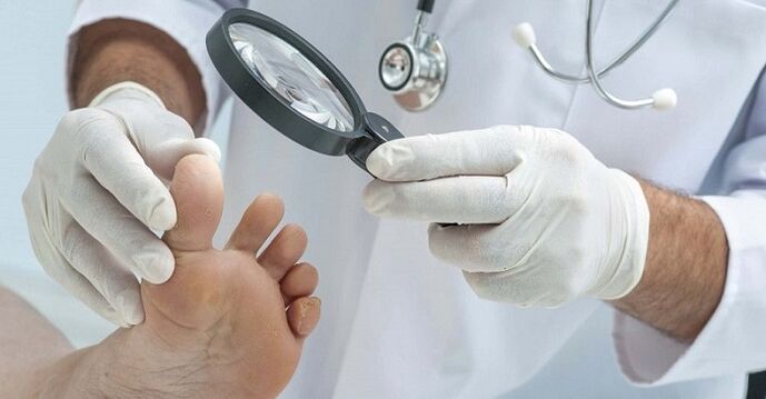 Ο γιατρός εξετάζει τα πόδια για μύκητα των νυχιών